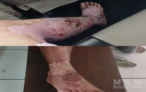 Karyawati Alami Luka Bakar Diduga Akibat Kecelakaan Kerja, Minta Perhatian Perusahaan